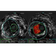 Contribute to laravel/jetstream development by creating an account on github. Jetstream Atherectomy System Boston Scientific