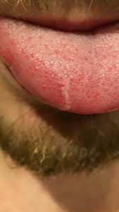 Maybe you would like to learn more about one of these? Syfilis Medische Forum Dokter Nl