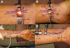 Deep cut on the palm side of the hand, wrist, or forearm can damage the tendons that bend the thumb. Flexor Pollicis Longus Tendoscopy Sciencedirect
