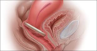 Image result for Pessary