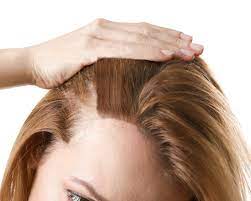 I will share what worked in my case. How I Grew My Hair Back Women S Hair Loss Amp Regrowth Success Stories Hair La Vie
