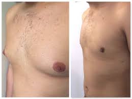 La structure de la glande mammaire est inachevée. Le Traitement De La Gynecomastie Chez L Homme