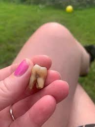 If you and your child feel that the tooth is ready brush and floss method: Mum Drank 4 Beers Before Pulling Out Own Tooth After Dentists Closed In Lockdown Mirror Online