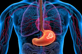 If you have been diagnosed with adenocarcinoma cancer, you have a cancer that developed in one of the glands that lines the inside of your organs. Stomach Gastric Cancer Penn Medicine