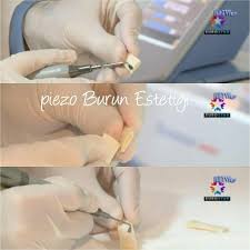 Bulent Koc Adli Kullanicinin Piezo Burun Estetigi Ameliyati Panosundaki Pin