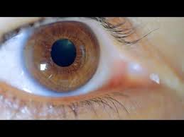 Black And Blue Eyes After Head Injury Pin On Senior Citizens