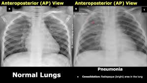 Image result for Air Bronchogram