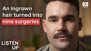 Caso : Injerto conectivo protección zona donante con apósito intraoral