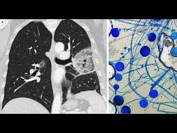Maybe you would like to learn more about one of these? Pulmonale Mukormykose Youtube