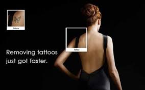 Tattoo decisions of your past don't have to be a permanent part of your image with expert laser tattoo removal seattle and tattoo coverups offered at caddell's laser & electrolysis clinic. Tattoo Removal Seattle Laser Tattoo Removal Bellevue