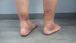 Image result for erythema nodosum