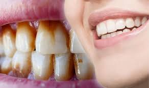 Conversely, carbamide peroxide releases about 50% of its whitening power in the first two hours and can remain. How To Remove Brown Stains From Teeth Express Co Uk