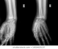 Check spelling or type a new query. Schedel Ap Lateral Radiology X Ray Stock Photo Edit Now 1457398577 Radiology X Ray Photo Editing
