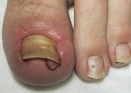 ingrown toenail treatment causes