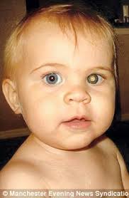 Changes in the eyes, such as black eyes, a droopy eyelid, a pupil that is constricted. Baby Saved After Friend Spots Eye Cancer Clue In Photograph Emailed By Girl S Mother Daily Mail Online