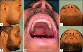 Non-vascularized Fibular Cortex Grafts with Osteocutaneous Free Fibula  Transfer: A Novel Technique in Midface Reconstruction