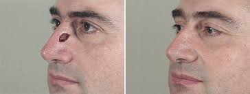 Some types of skin cancer are more dangerous than others, but if you have a spot. Skin Cancer Treatment In Paramus New Jersey Parker Center For Plastic Surgery
