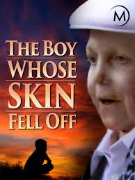 Prime Video: The Boy Whose Skin Fell Off