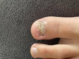 Image result for mykoza nehtů