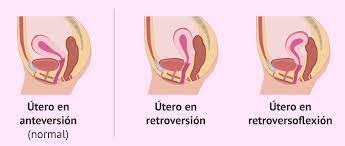 Qué es el útero retroverso? 
