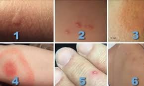 Etes Vous Capable De Reconnaitre Les Piqures D Insectes Pour Pouvoir Reagir De La Bonne Facon Piqure Insecte Piqure De Tique Piqure De Puce