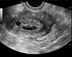 Endometrial Hyperplasia Radiology Reference Article Radiopaedia Org Endometrial Hyperplasia Radiology Ultrasound