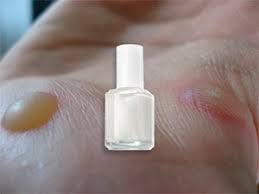 nail polish on wart does it work