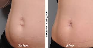 Belly Button Plastic Surgery In Nyc Plastic Surgery News For New York City From Dr Thomas P Sterry