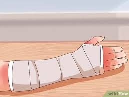 We did not find results for: Cara Memasang Gips Untuk Patah Lengan 14 Langkah Dengan Gambar