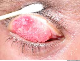 Image result for Gonococcal Conjunctivitis