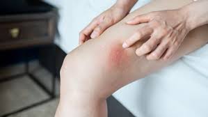 Image result for sore skin in the groin area