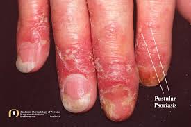 Image result for Pustular Psoriasis