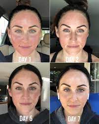 Check spelling or type a new query. My Experience W Microneedling Why I M Obsessed Paleomg