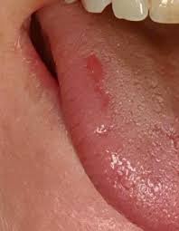 Andre områder der det kan oppstå. Sar Pa Tungekanten Ser Dette Farlig Ut Se Bilde Blir Glad For Svar Kropp Og Helse Kvinneguiden Forum