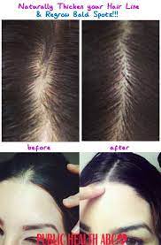 4.4 out of 5 stars 652 ratings | 5 answered questions Can Castor Oil Cures Baldness Health Beauty Abc Natural Beauty Tips Beauty Tips And Tricks Diy Beauty Life Hacks Grow Long Hair Regrow Hair Hair Remedies