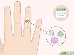 Showing relevant, targeted ads on and off etsy. 5 Ways To Get Rid Of Warts Wikihow