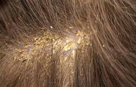 How To Treat Scabs On The Scalp In 2020 Dandruff Causes Dry Scalp Treatment What Causes Dandruff