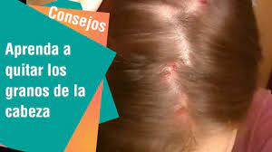 Aprenda A Quitar Los Granos De La Cabeza Consejos Para Usted Youtube