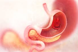 Early stage stomach cancer symptoms. Do You Know The Early Signs Of Gastric Cancer Healthversed