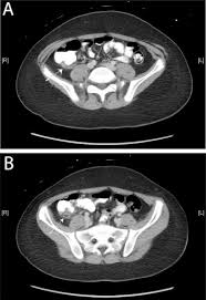 Maybe you would like to learn more about one of these? Cecal Epiploic Appendagitis Mimicking Appendicitis Sciencedirect
