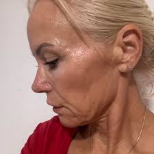 Has anyone had a SMAS neck lift? Here is my before, top left, and now three  weeks out. It's going right back where it was. Doc says skin will tighten  over the