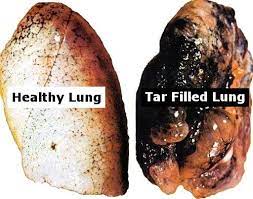 Detox Your Lungs From Tar - Posts | Facebook
