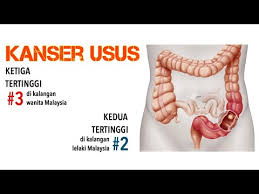 We did not find results for: Apa Itu Kanser Usus Punca Kanser Usus Tanda Awal Kanser Usus Cara Cegah Dan Rawat Kanser Usus Youtube