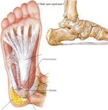 Fersensporn Plantarfasziitis Lauftipps Das Grosse Laufportal