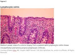 Image result for Microscopic Colitis