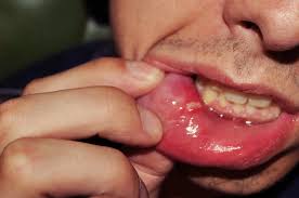 Today this article will explain why the roof a small, sometimes slightly painful bump on the roof of your mouth is generally harmless and clears up within a week or so. Bump On Roof Of Mouth Is It A Serious Problem Tripboba Com