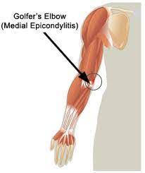 Quick answer, symptoms of this condition include feeling pain and tenderness on the bony part of the outside of the elbow. Get Rid Of Inner Elbow Pain Aka Medial Epicondylitis Aka Golfer S Elbow B Reddy Org