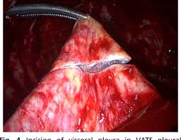 This cancer develops in the layer of tissue that covers many internal organs in the body. Figure 4 From Pleurectomy Decortication In The Treatment Of The Trapped Lung In Benign And Malignant Pleural Effusions Semantic Scholar