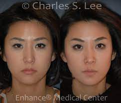 He then lifts the forehead skin to enhance the brow line and eliminate horizontal wrinkles. Non Surgical Browlift Midfacelift Lip Corner Lift Charles S Lee Md