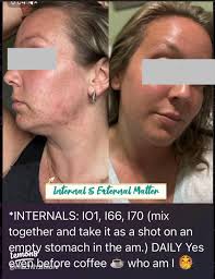 Understanding Skin Purging: What You Need to Know